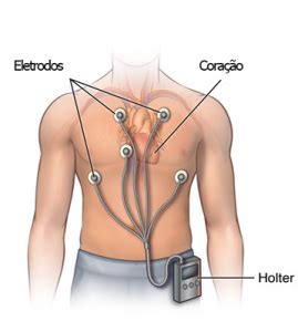 Exame De Holter Saiba O Que Para Que Serve E Como Feito