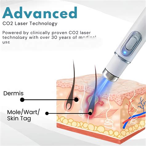 Non-Invasive Acne & Wart Removal Laser Pen with Heating (No Side Effec