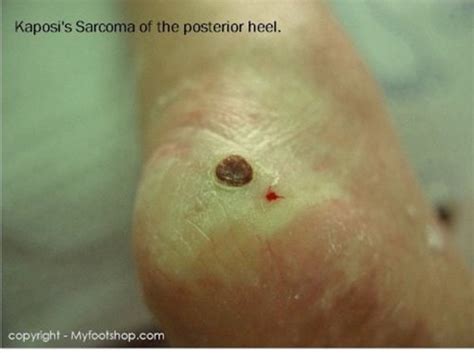 Tumors Of The Foot Causes And Treatment Options Myfootshop