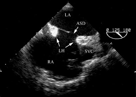 Atrial Septal Defect Device Closure In A Patient With Lipomatous