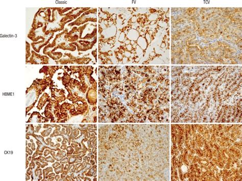 Immunohistochemical Expression Of Galectin 3 HBME1 And CK19 In Three