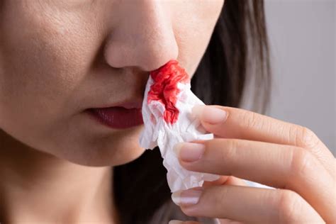 Nosebleed Stock Photos Pictures And Royalty Free Images Istock