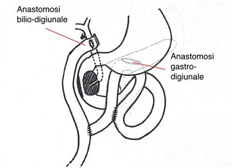 Chirurgia Del Pancreas Verona Bypass Operations For Cancer