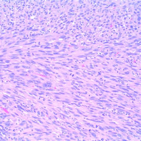 Histopathology Hematoxylin And Eosin Stain Of Re Biopsy Showed