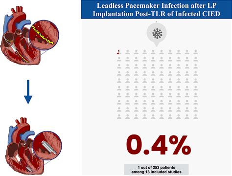 A Systematic Review Of Short Term Outcomes Of Leadless Pacemaker