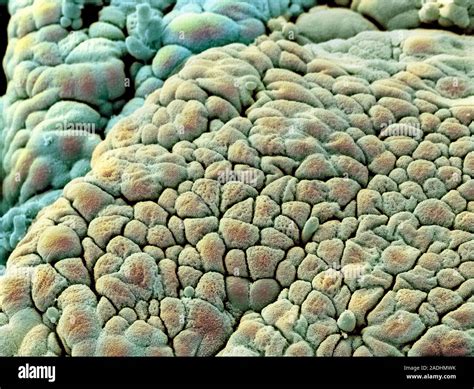 Rectal Polyp Coloured Scanning Electron Micrograph Sem Of The