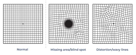 Amsler Grid Test Distortions