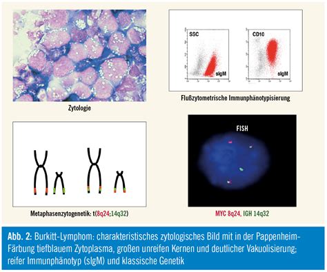 Pädiatrische Lymphome | Spectrum Onkologie | MedMedia