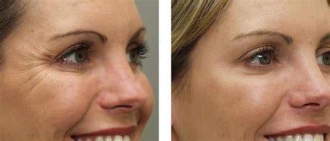 Botox Treatment In Denver Dtc Centennial Laser Aesthetics Of Colorado