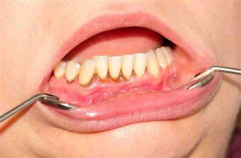 Cu Les Son Los S Ntomas De La Gingivitis Estudi Dental Barcelona