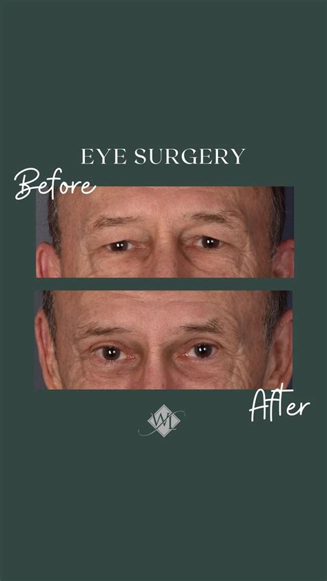 Before and After Eye Surgery | Eye surgery, Forehead lift, Eyelid surgery