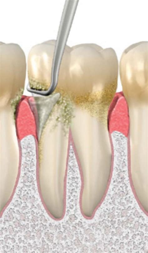 Rotten Wisdom Teeth Food Dentistasp Wisdomteethcartoon Dental