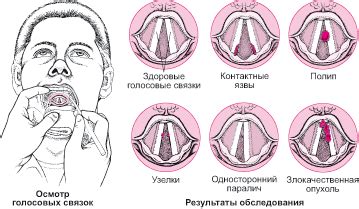 Table: Заболевания голосовых связок - Справочник MSD Версия для ...