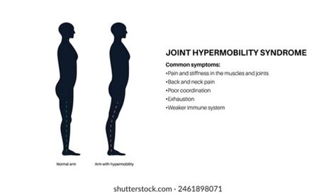 Joint Hypermobility Syndrome Hypermobility Spectrum Disorder Stock