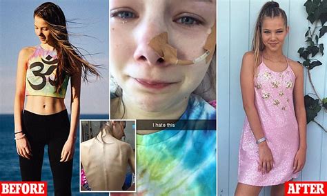 Budding Model Shares Struggle With Anorexia Daily Mail Online