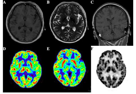 Brain MRI images did not show abnormalities associated with the ...