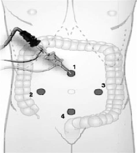 Positions Of The Trocars In Laparoscopic Sigmoidectomy Download Scientific Diagram