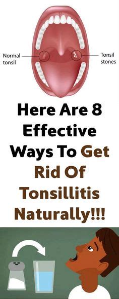 Tonsillitis