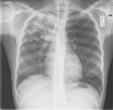 Tuberculosis Vs Pneumonia X Ray