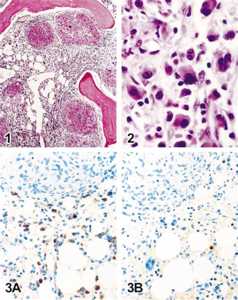 Figure 2 From Multiple Myeloma In Association With Sarcoidosis Semantic Scholar