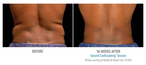 CoolSculpting Flank Back Before And After Photos NYC