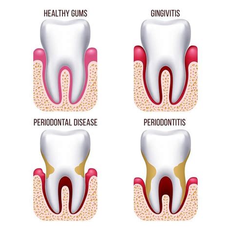 Enfermedad Periodontal Diferencias Entre Periodontitis Y Gingivitis Hot Sex Picture