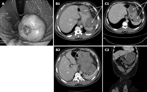 Modern Treatment Of Gastric Gastrointestinal Stromal Tumors