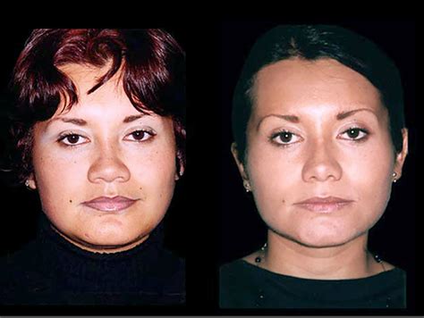 Rinoplastia Para Nariz Ancha Con Resultados Increíbles True Doctors