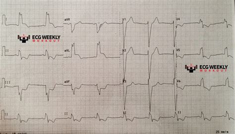 Stat Ecg Diagnoses Left Bundle Branch Block Lbbb Basics And Expected