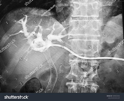 Percutaneous Transhepatic Cholangiography