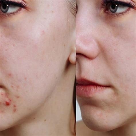 Kem trị mụn mờ thâm Acne Derm Kwas Azelainowy 20g An Beauty