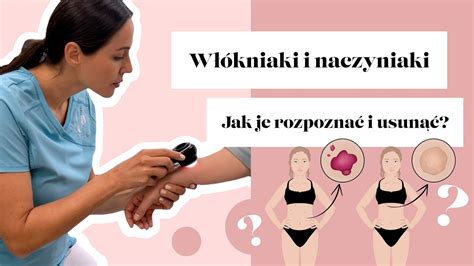 Włókniaki i naczyniaki jak je rozpoznać i usunąć YouTube