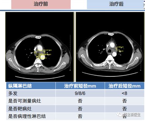 壹生资讯 实体瘤疗效评价标准全面解读！附实例！