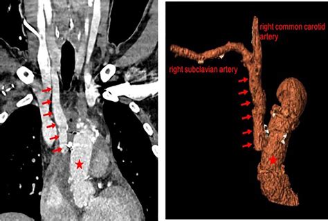 Uni Versus Bilateral Antegrade Cerebral Perfusion During Repair Of