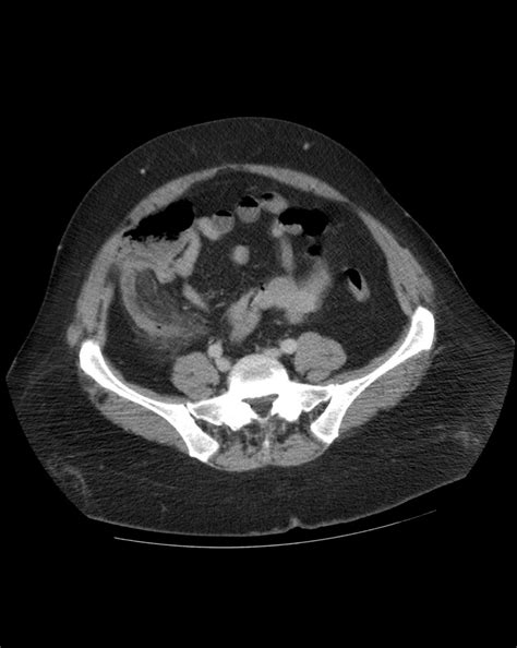 Post Gad: Acute Appendicitis