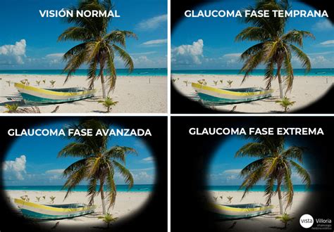 ¿hay Varios Tipos De Glaucoma¿qué Síntomas Tienen Clínica Villoria