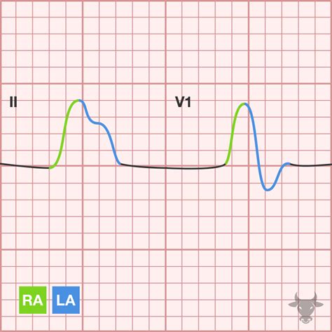 Left Atrial Enlargement | ECG Stampede