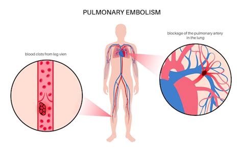 Premium Vector Pulmonary Embolism Disease