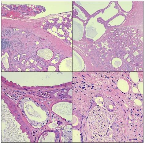 Microscopic Images Showing Proliferation Of Acini Ducts And Cysts