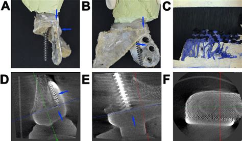 A Femur Defect Reconstructed By A Three Dimensional 3d Printed Porous