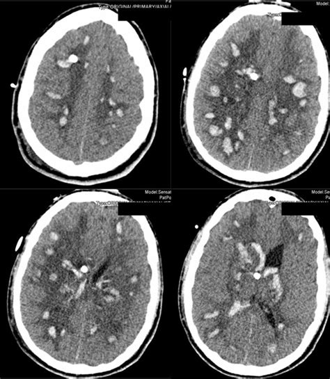 Hemorragia Cerebral Multifocal Espontánea Medicina Intensiva