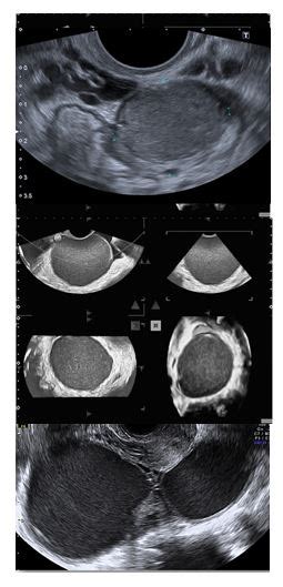 L imagerie dans le diagnostic de l endométriose APHP