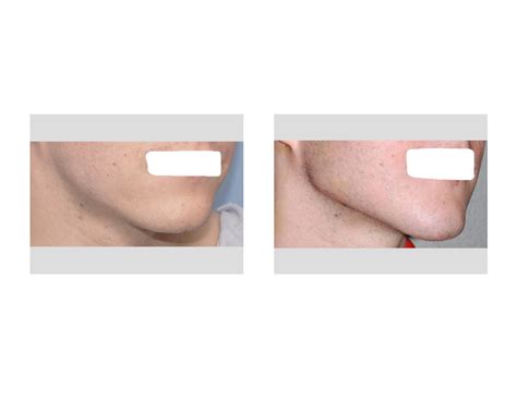 Custom Jawline Implant Result Oblique View Explore Plastic Surgery