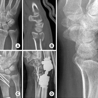 A Anteroposterior Plain Radiograph Showing Intra Articular Distal