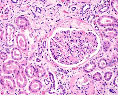 Diabetic Nephropathy Light Micrograph Stock Image C