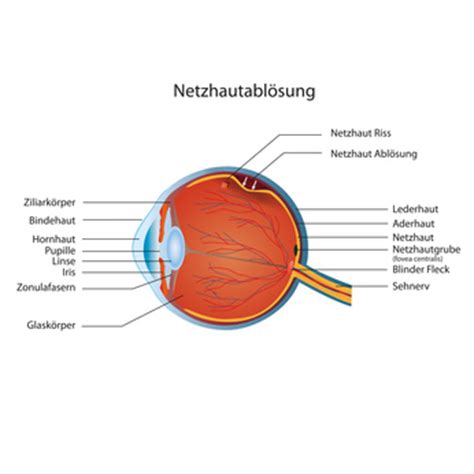 Netzhautabl Sung Ursachen Symptome Behandlung Medlexi De