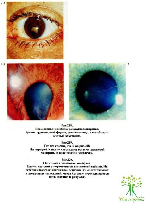 Опухоль сосудистого тракта: что это такое, его симптомы и лечение