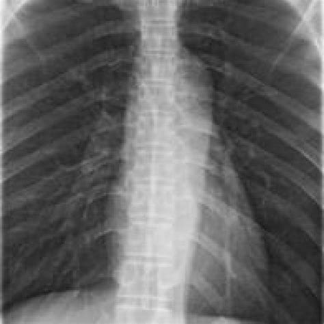 Antero Posterior View Of The Thoracic Spine Radiograph Soft Tissue Download Scientific Diagram