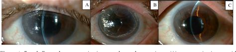 Figure 6 From Challenges Of Dmek Technique With Young Corneal Donors