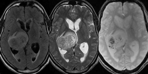 Glioma: Glioma Anaplastic Astrocytoma Brain Tumor